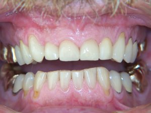 After CEREC