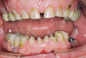 Full mouth rehab before