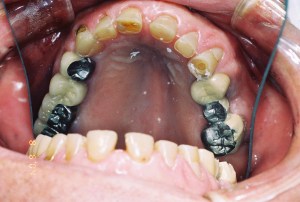 Full mouth rehab before