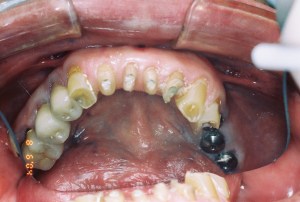 Full mouth rehab before