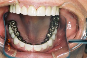 After full mouth rehab