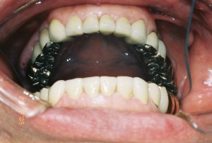 After full mouth rehab
