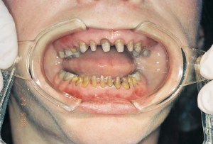 teeth after their preparation for all porcelain jackets