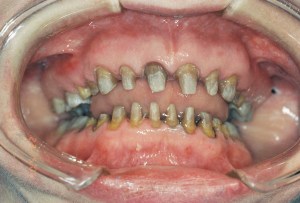 teeth after their preparation for all porcelain jackets